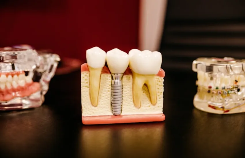 Implanty dentystyczne – nowoczesne rozwiązanie dla pięknego uśmiechu