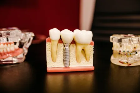 Implanty dentystyczne – nowoczesne rozwiązanie dla pięknego uśmiechu